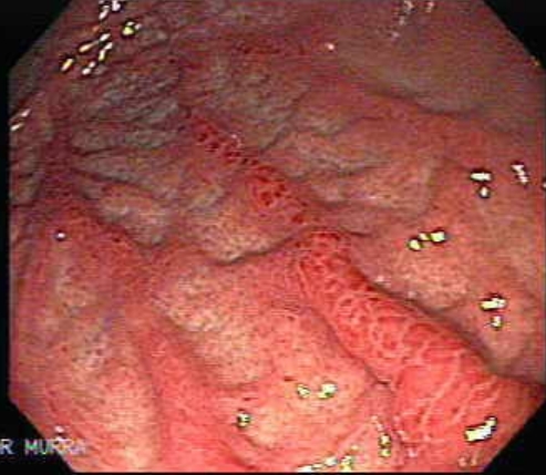 gastritis acuta